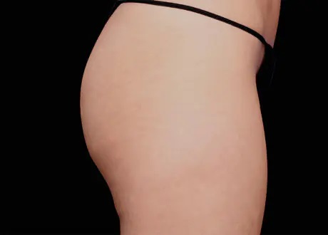 Emsculpt-Buttocks-After