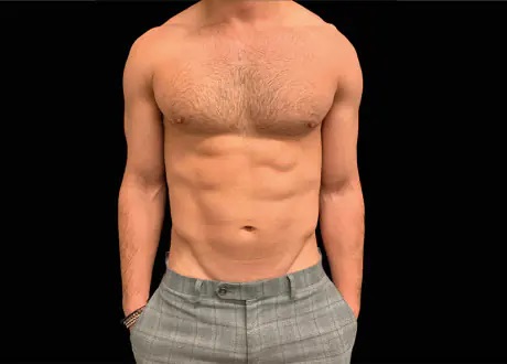 Emsculpt-Male-Abdomen-After-Abdomen