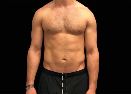 Emsculpt-Male-Abdomen-Before (1)