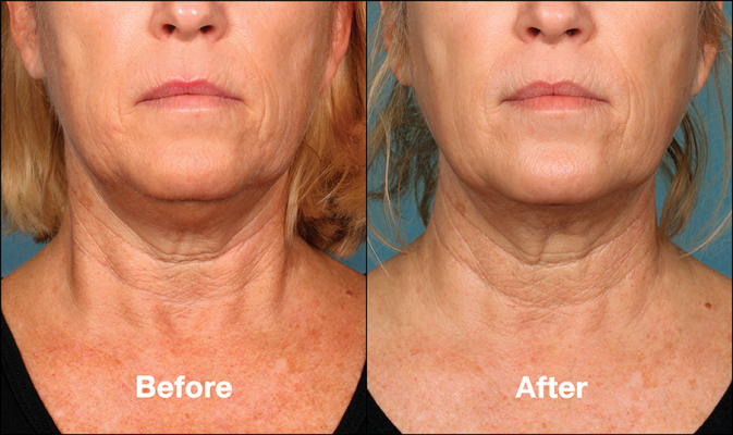 Kybella-Double-Chin-Front-Before-After-3-e1470940022478