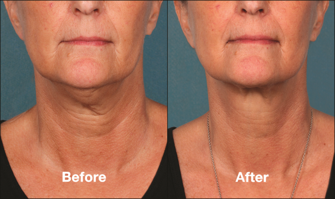 Kybella-Double-Chin-Front-Before-and-After-2-e1470939983184