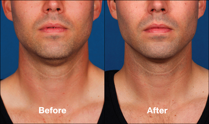 Kybella-Double-Chin-Front-Before-and-After-e1470939954420