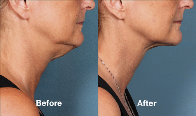 Kybella-Double-Chin-Side-Before-After-2-e1470939999546
