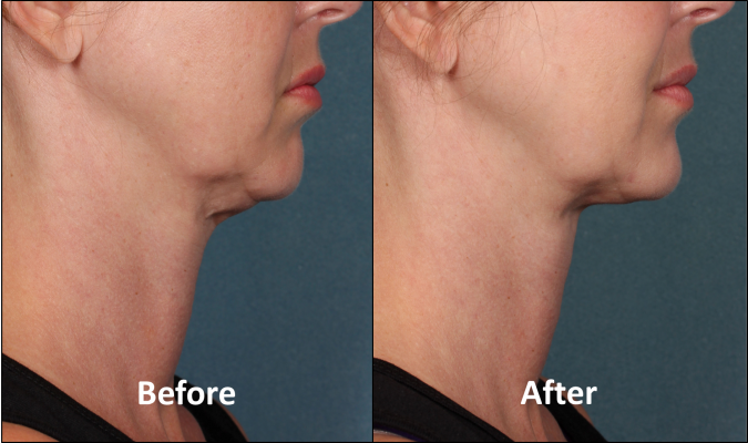 Kybella-Double-Chin-Side-Before-After-3-e1470940011310