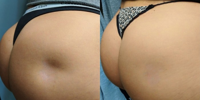 Renuva-Body-Before-After