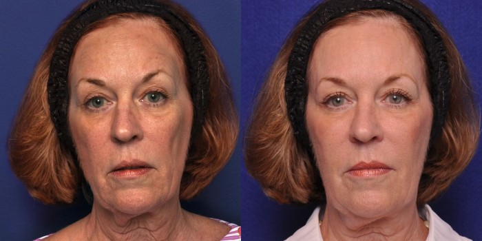 Renuva-Face-Before-After