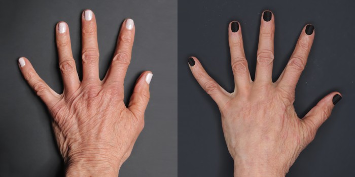 Renuva-Hands-Before-After