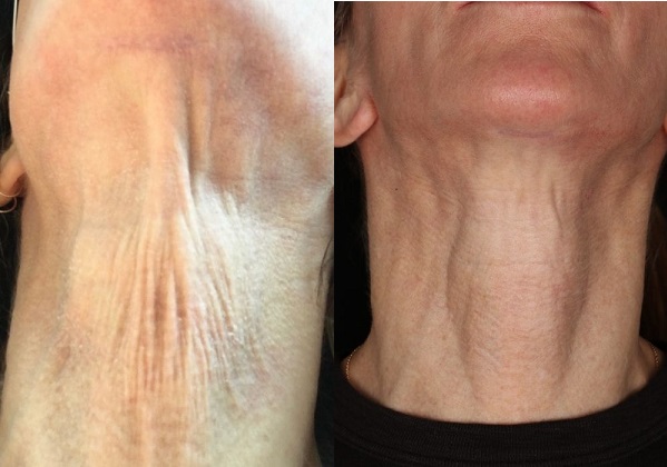Renuva-Neck-Before-and-After