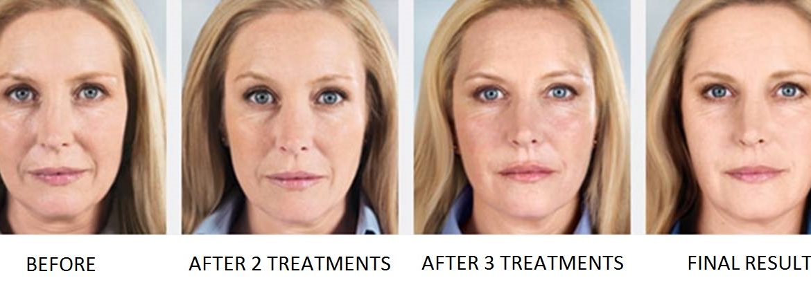 Sculptra-Fillers-Austin-Before-and-After-1-1