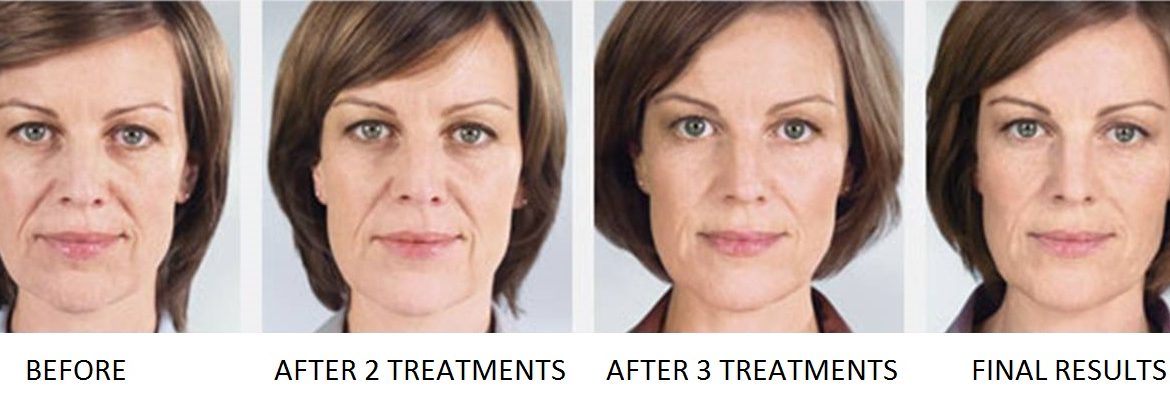 Sculptra-Fillers-Austin-Before-and-After-2-1
