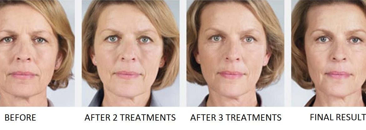 Sculptra-Fillers-Austin-Before-and-After-3-1