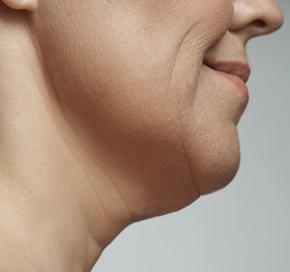 Double chin removal, facelift and neck liposuction
