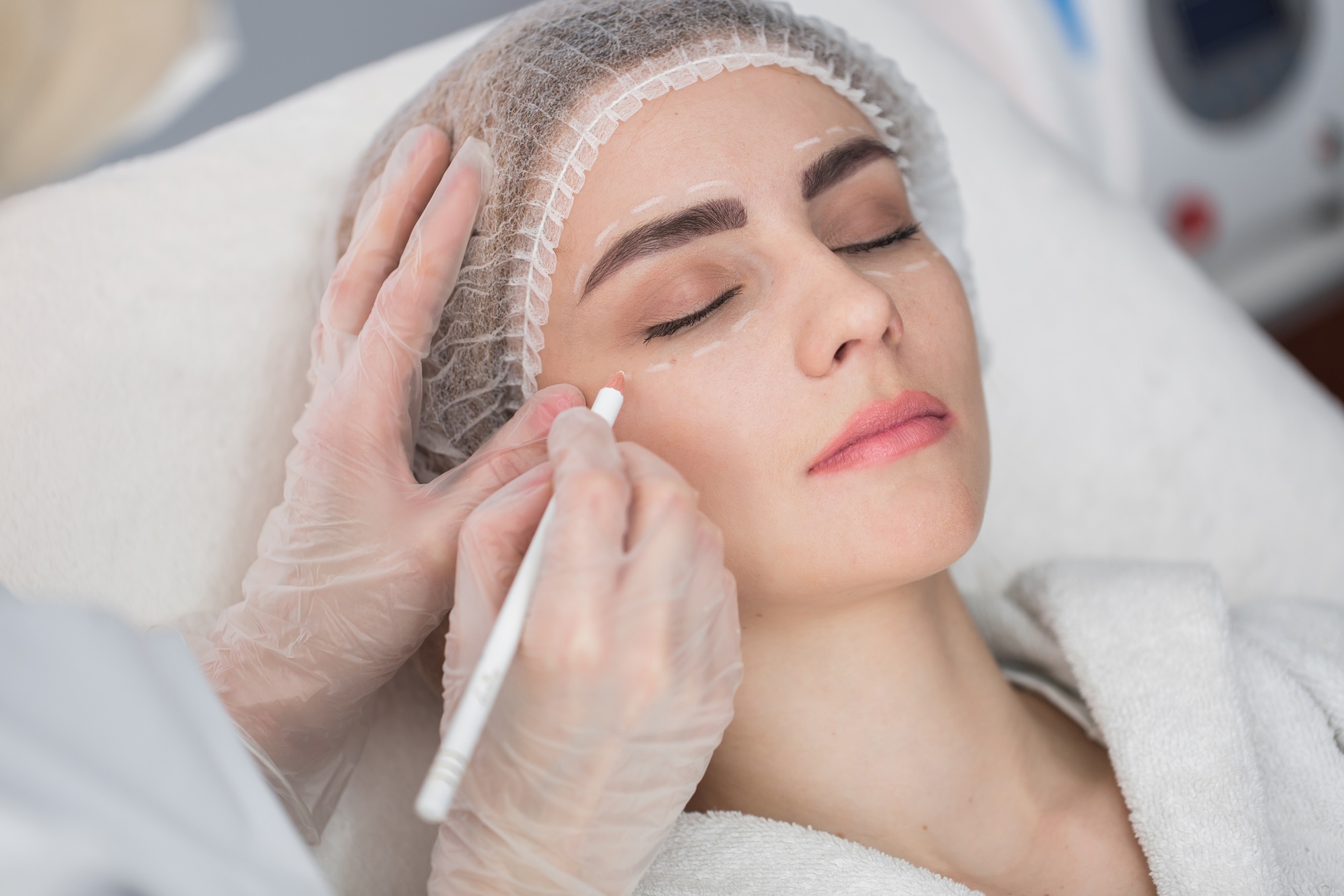 Woman with perforation lines on her face before plastic surgery operation.