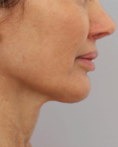 4-5_profound_ba_after2