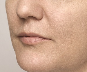 Deflated-Cheeks-Austin