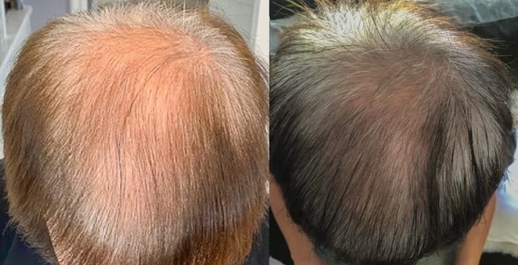 Exosomes-before-and-after-1