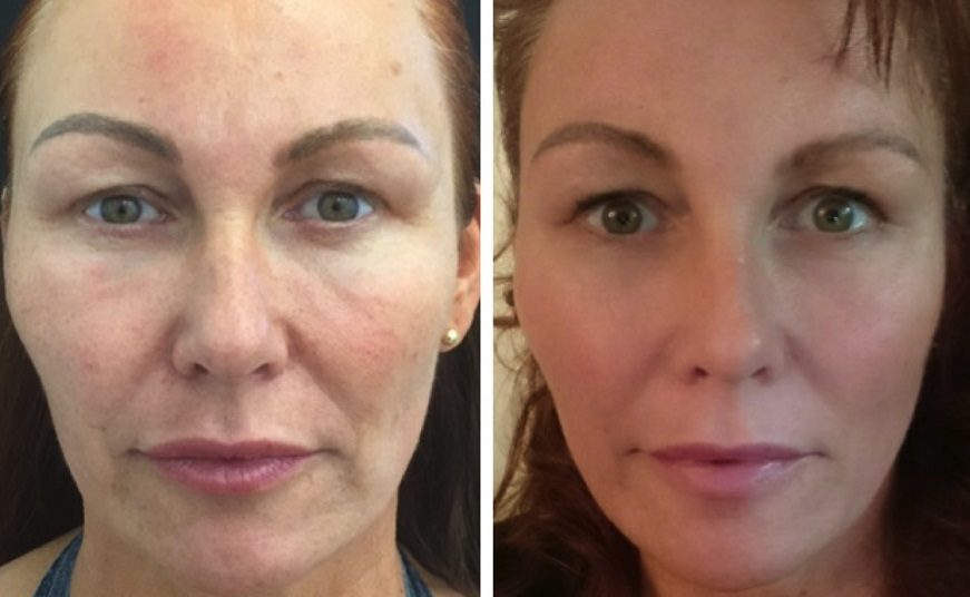 Threa-LIft-Face-BeforeAfter