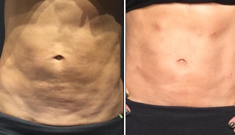 ThreadLift-Before-After-Abdomen