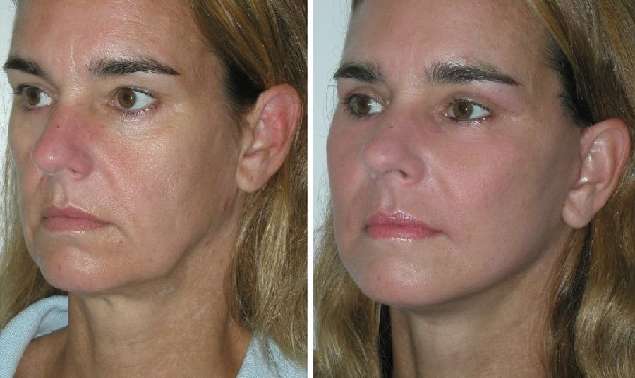 ThreadLift-BeforeAfter-Jowls