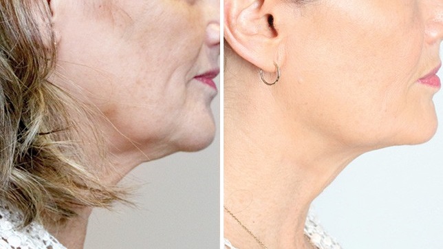 ThreadLift-BeforeAfter-Neck