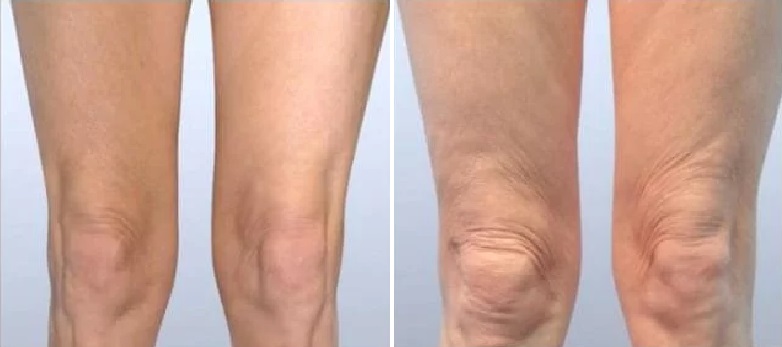 ThreadLift_BeforeAfter-Knees