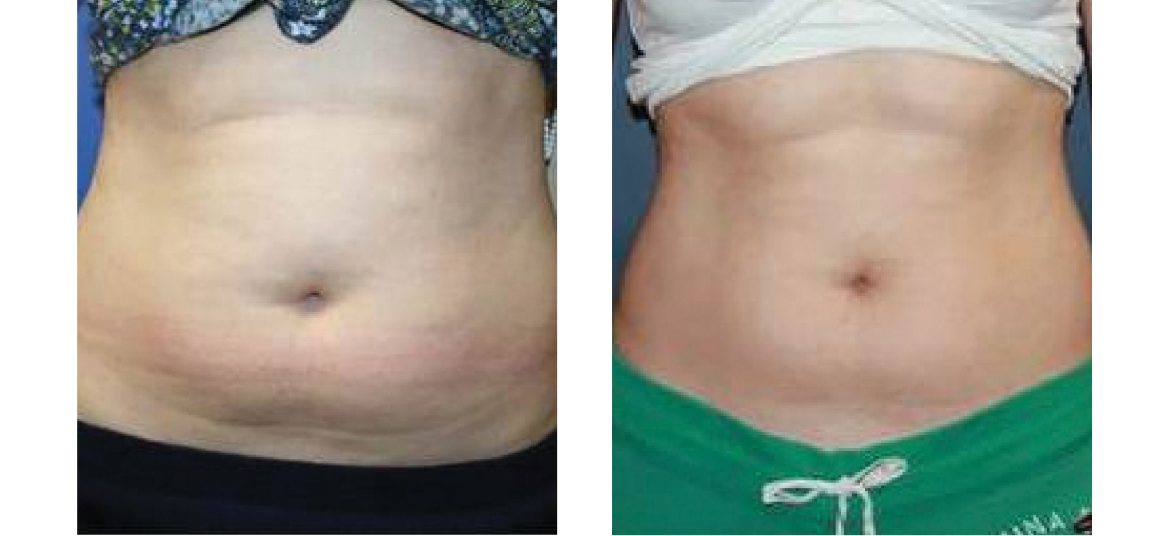 Venus-Freeze-Body-Contouring