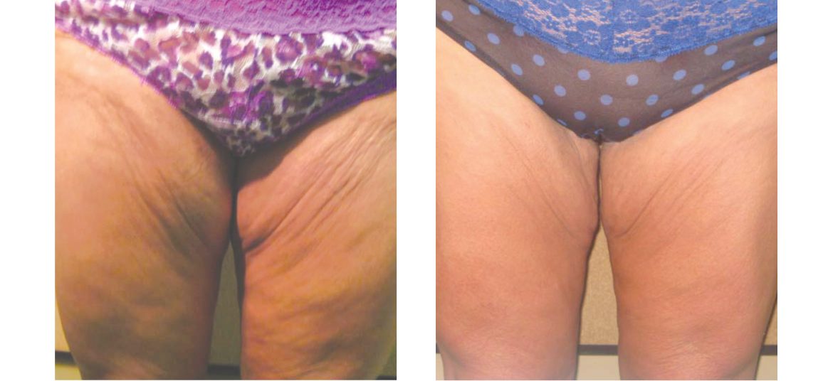 Venus-Freeze-Skin-Tightening