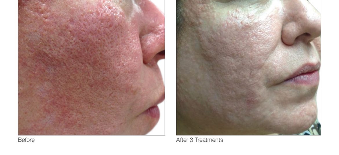 VenusViva_ZappiBuccheri_Face_3Tx