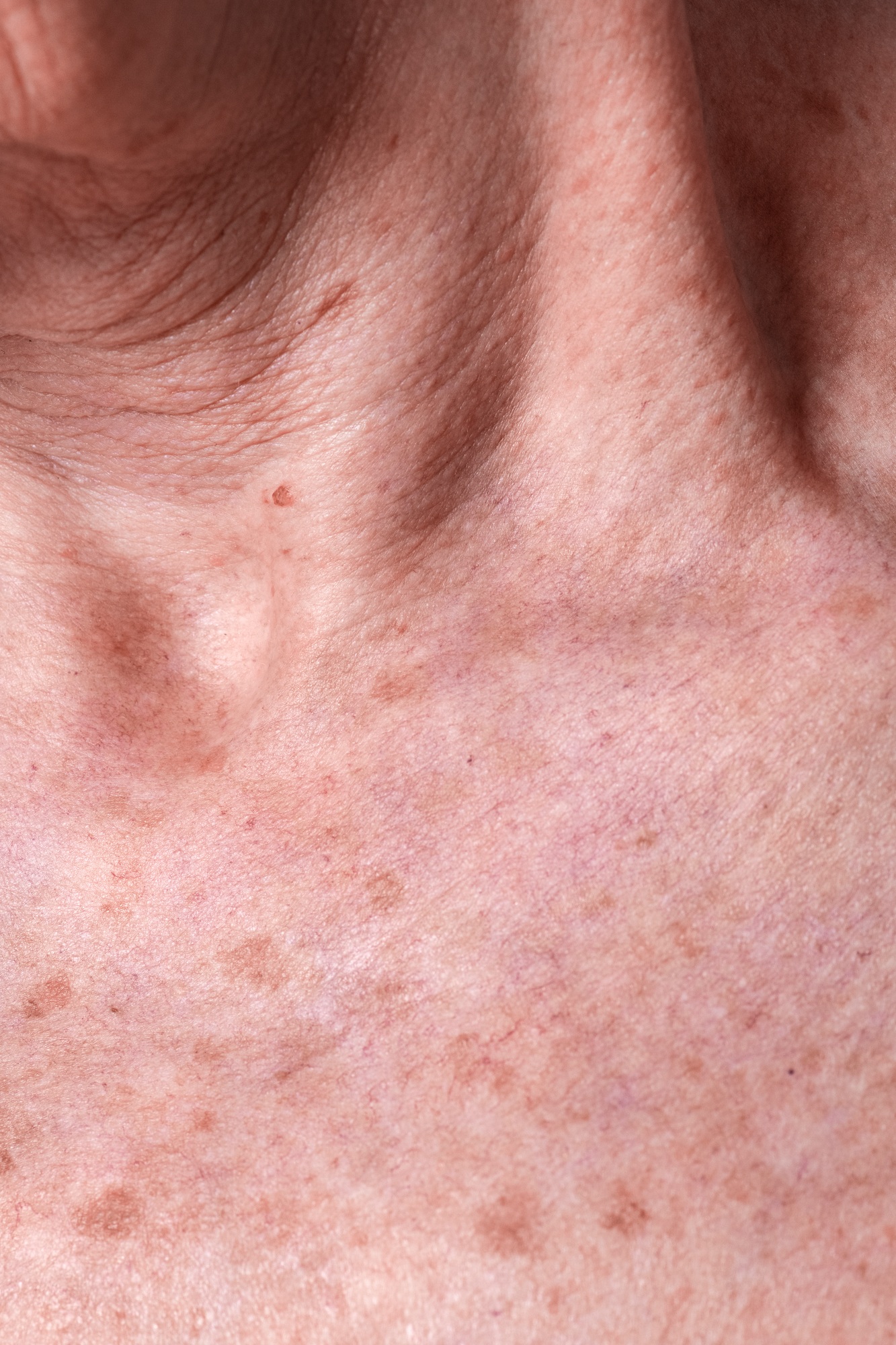 Aging female skin with melasma spots