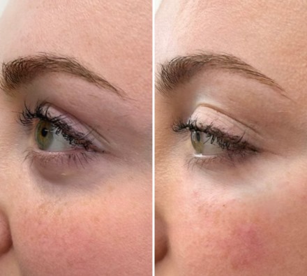 before-and-after-polynucleotide-3