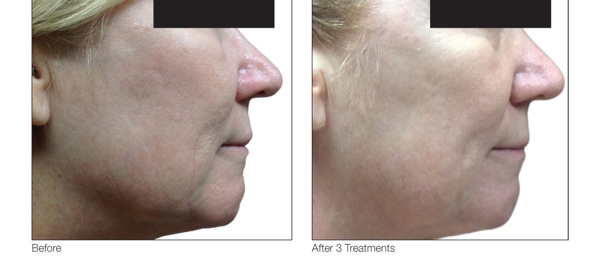 skin-resurfacing-austin-venus-viva-before-and-after