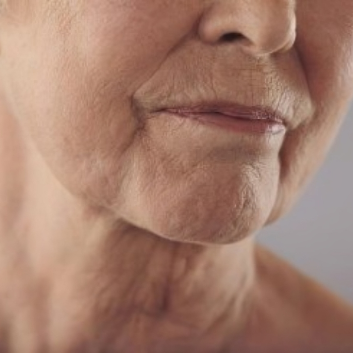 Chin-Wrinkles-e1459449861661