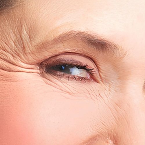 Crows-Feet-Wrinkles-Austin (1)