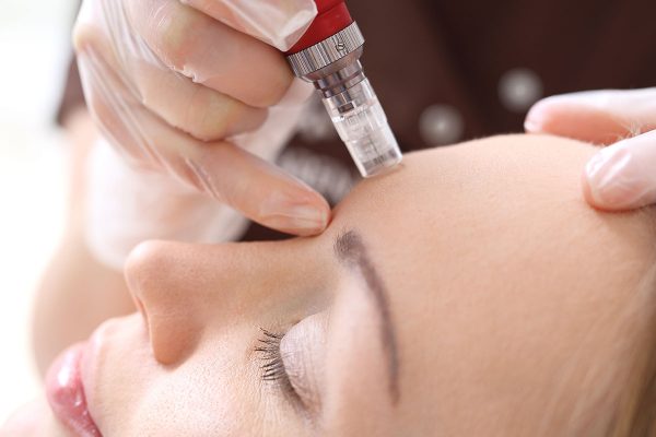 Microneedling-with-PRF