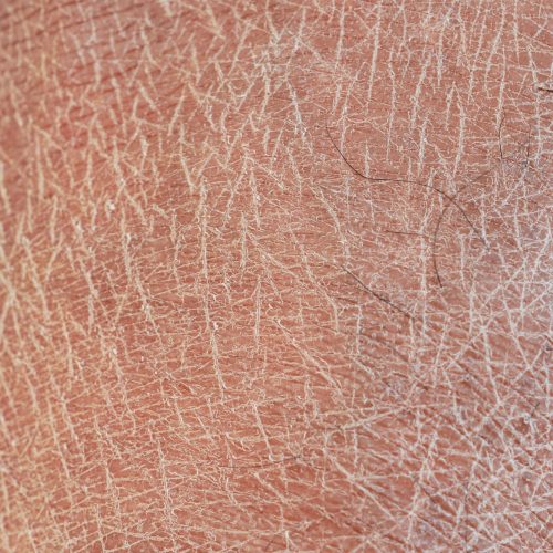 Closeup view of dry human skin .